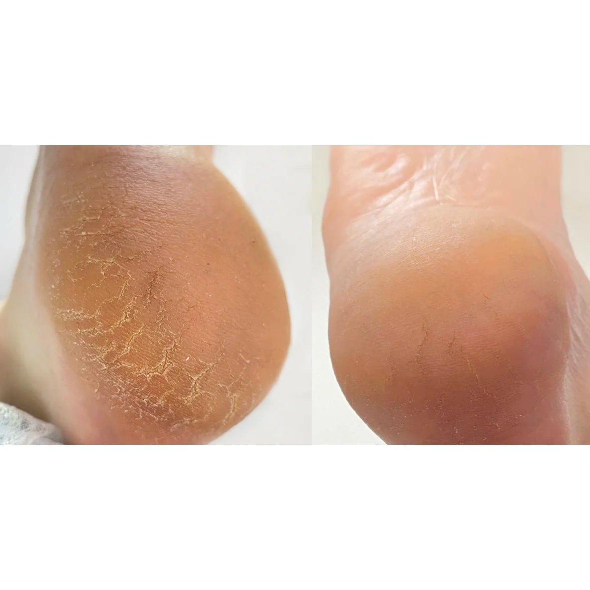 NAILSOFTHEDAY Anti-Crack Cream — cream for cracked skin on hands and feet, with 12% urea, 30 ml.