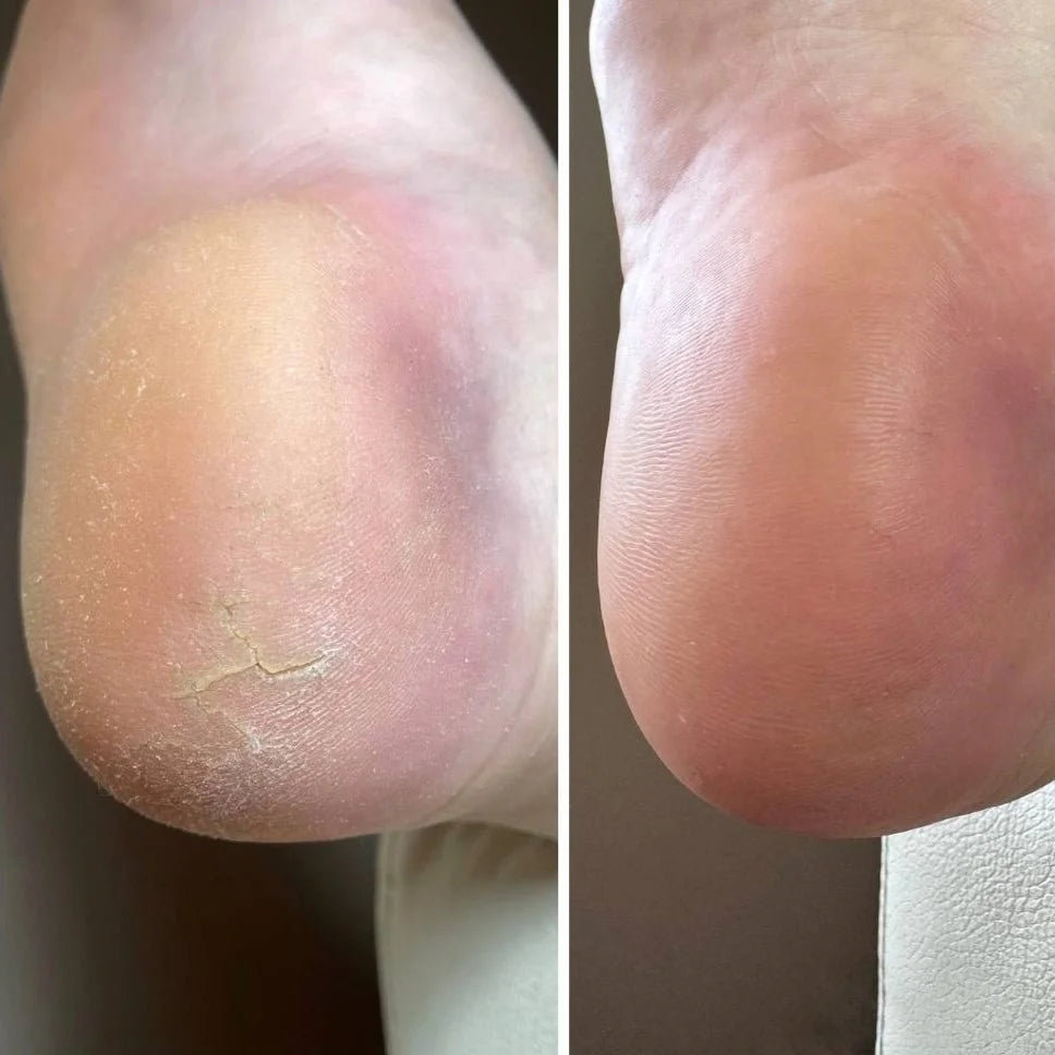 NAILSOFTHEDAY Anti-Crack Cream — cream for cracked skin on hands and feet, with 12% urea, 30 ml.