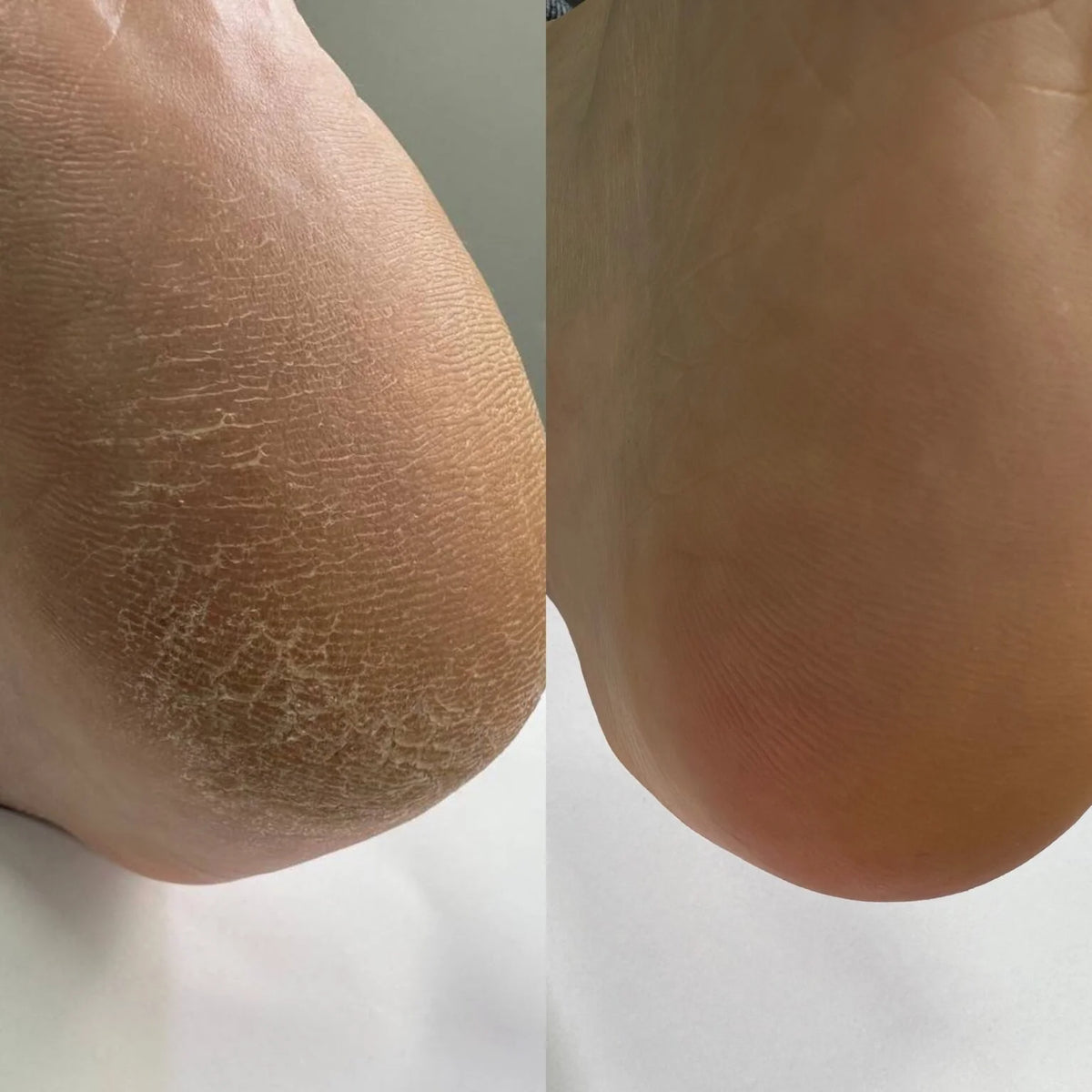 NAILSOFTHEDAY Keratolytic — Queratolítico para pies con Urea 20%, 100 ml