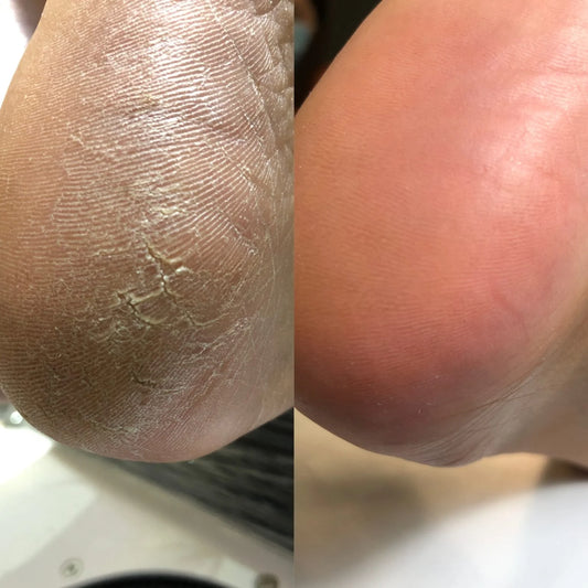 NAILSOFTHEDAY Keratolytic — Queratolítico para pies con Urea 20%, 100 ml